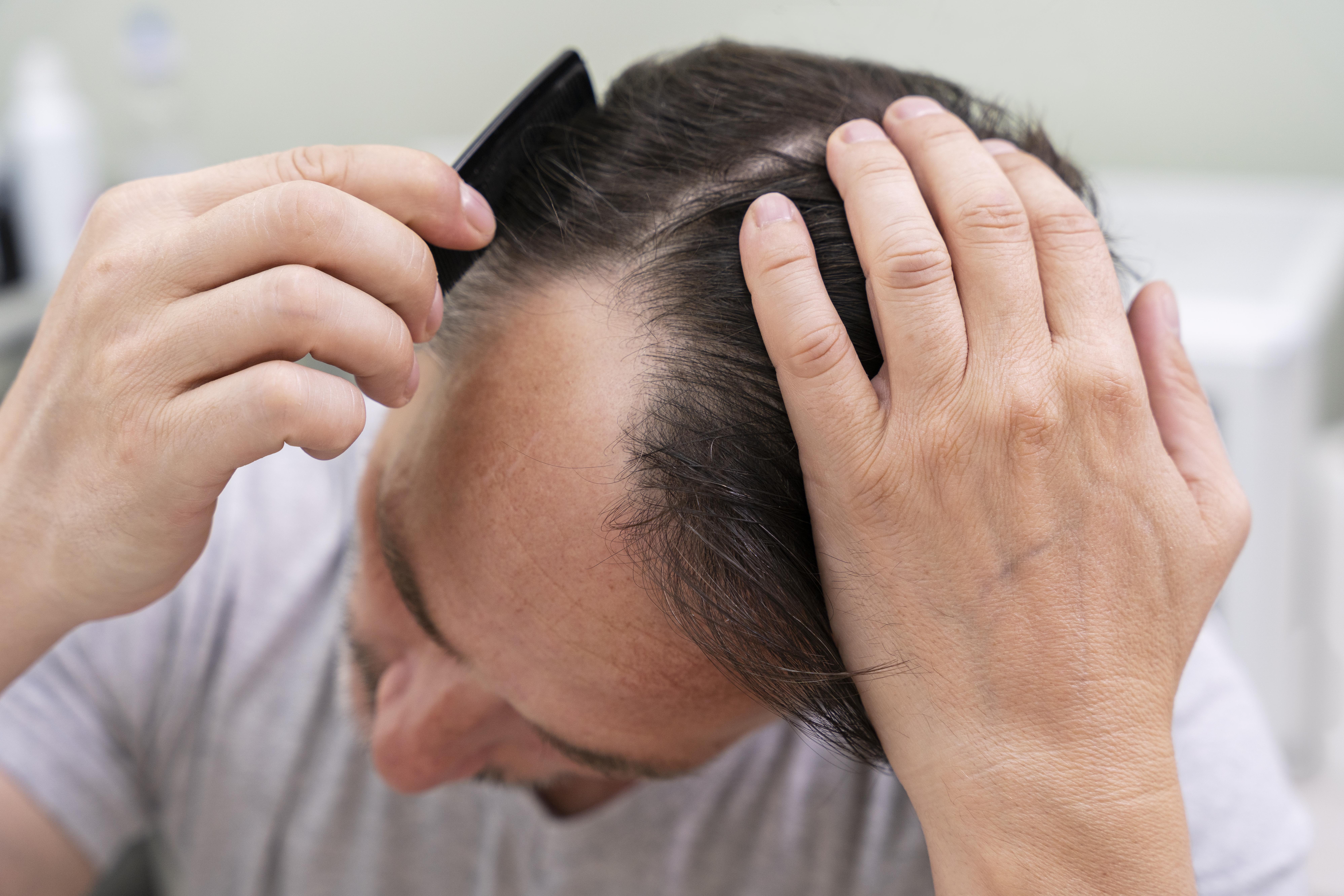 Dlaczego warto zainwestować w profesjonalne leczenie łysienia?
